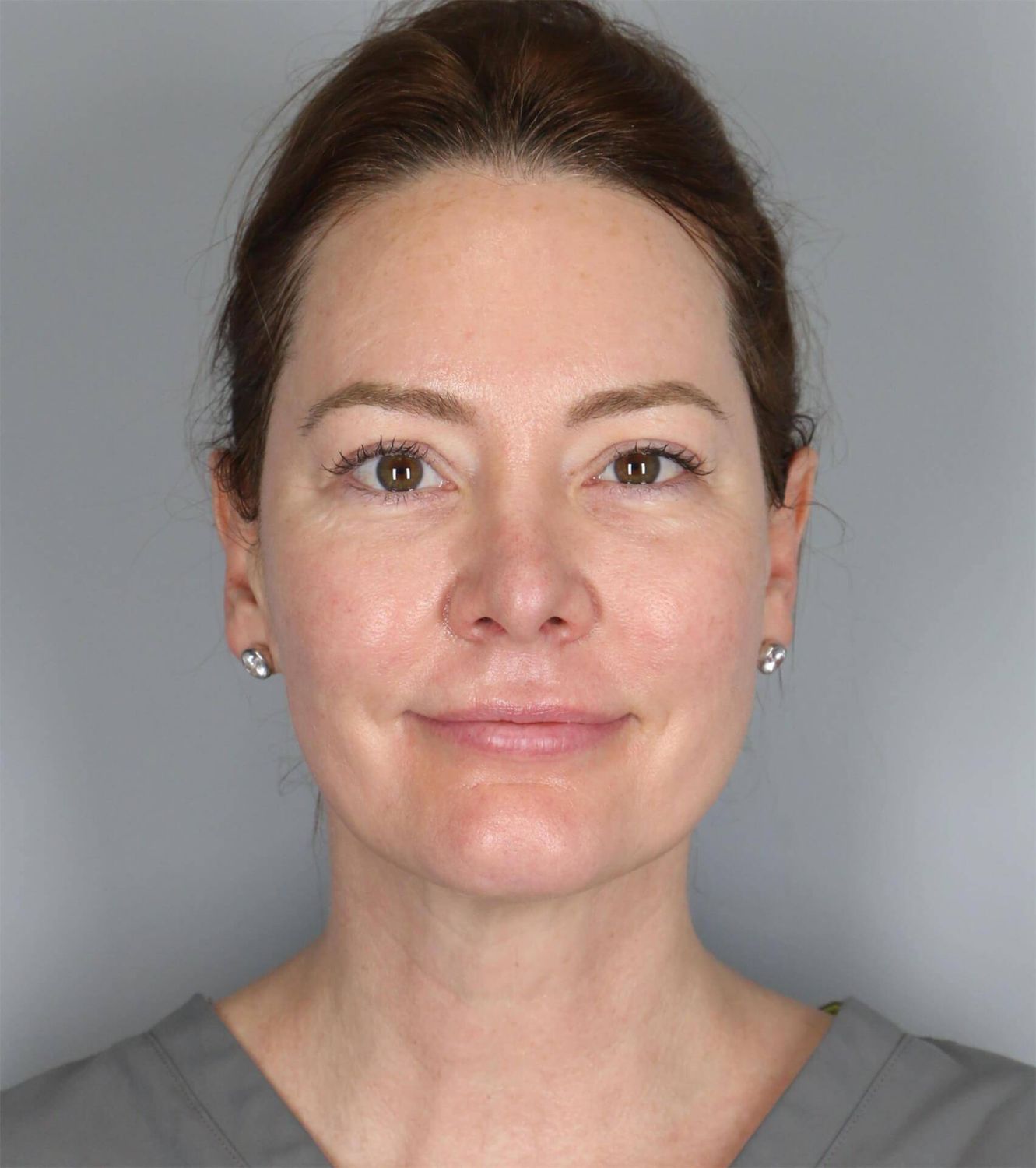 Morpheus8 Before & After