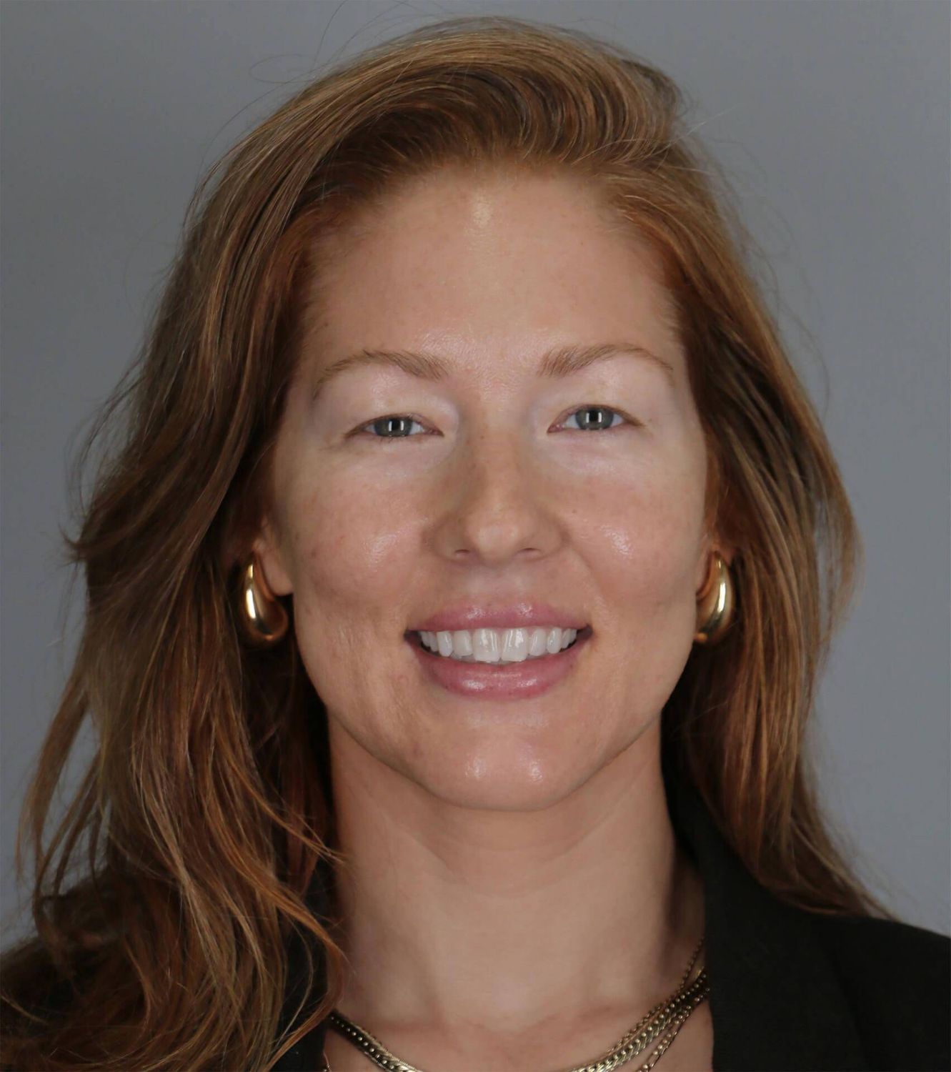 Morpheus8 Before & After