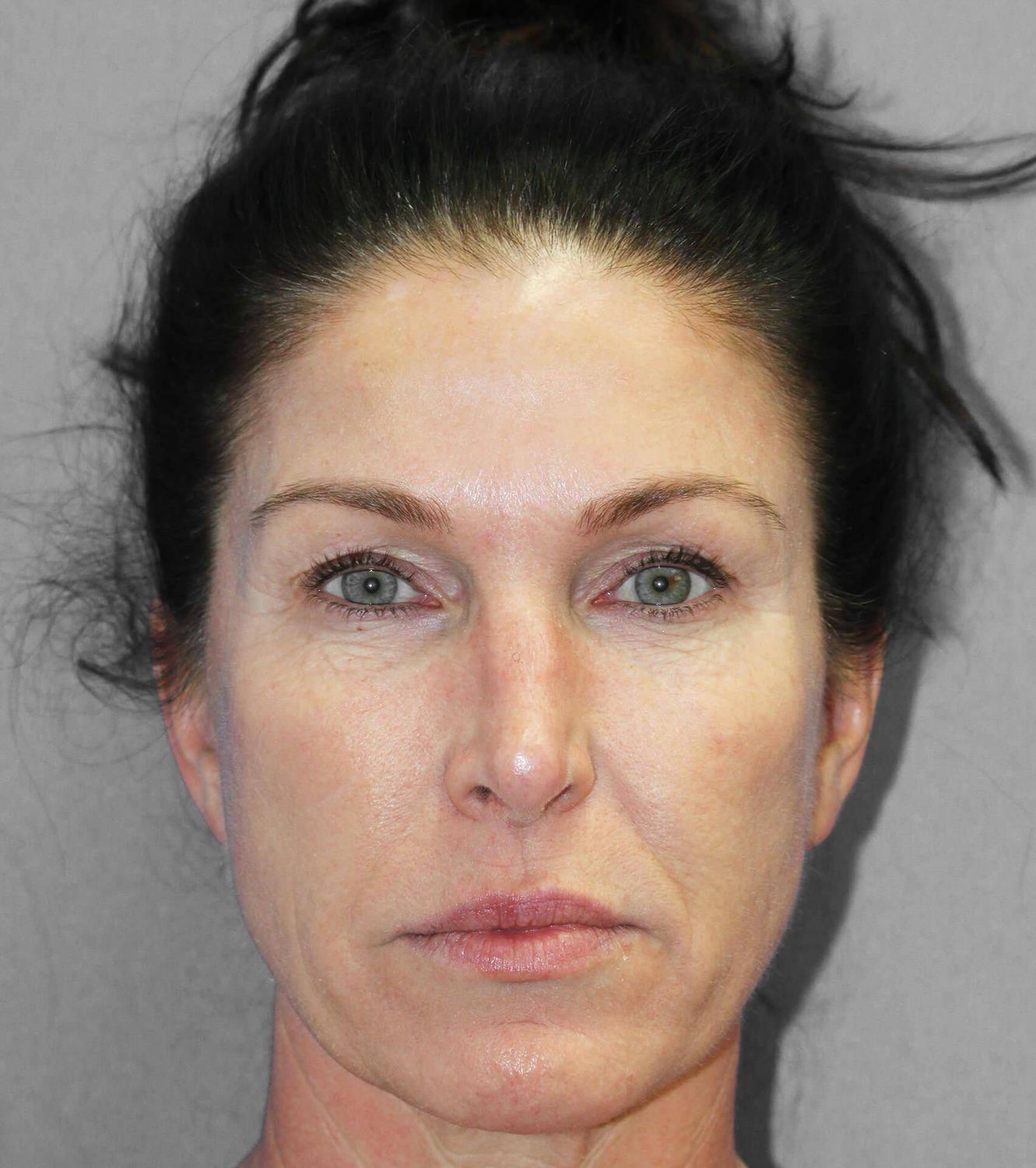 Co2 Laser Before & After