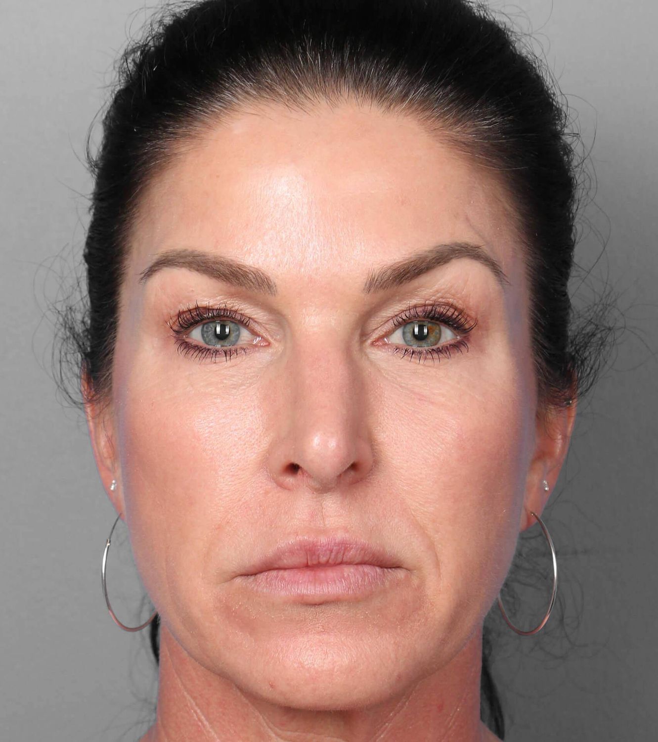 Co2 Laser Before & After