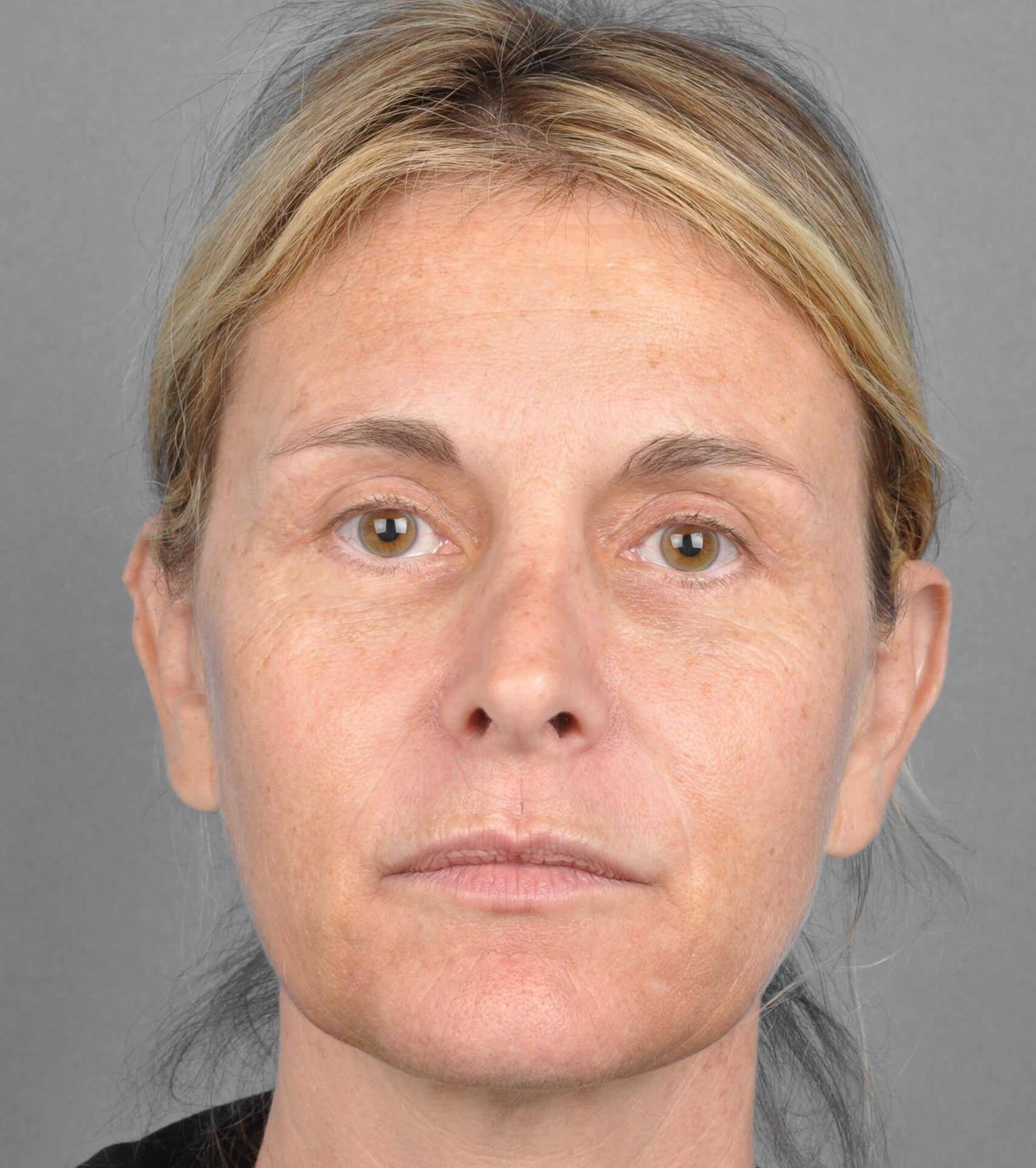 Co2 Laser Before & After