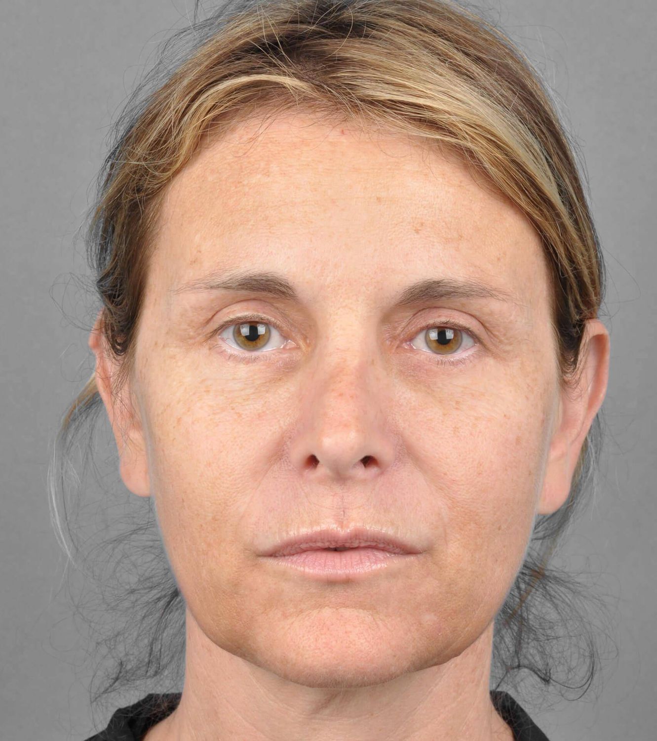 Co2 Laser Before & After