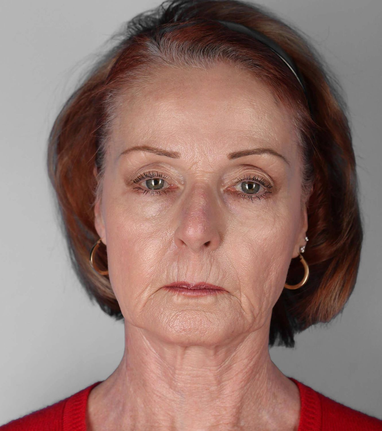 Co2 Laser Before & After