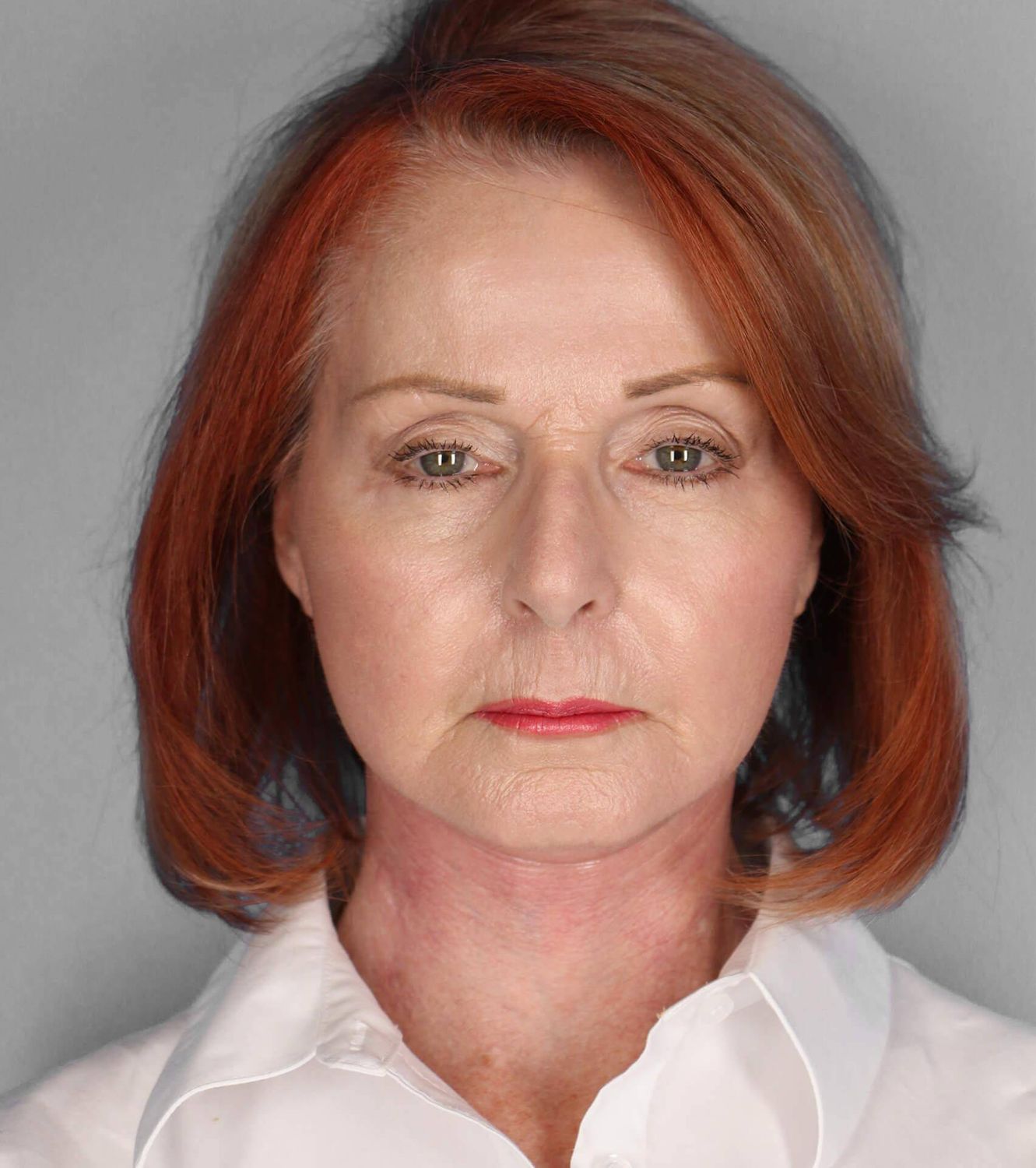 Co2 Laser Before & After