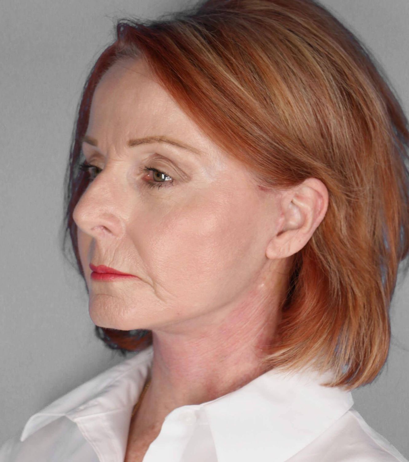 Co2 Laser Before & After