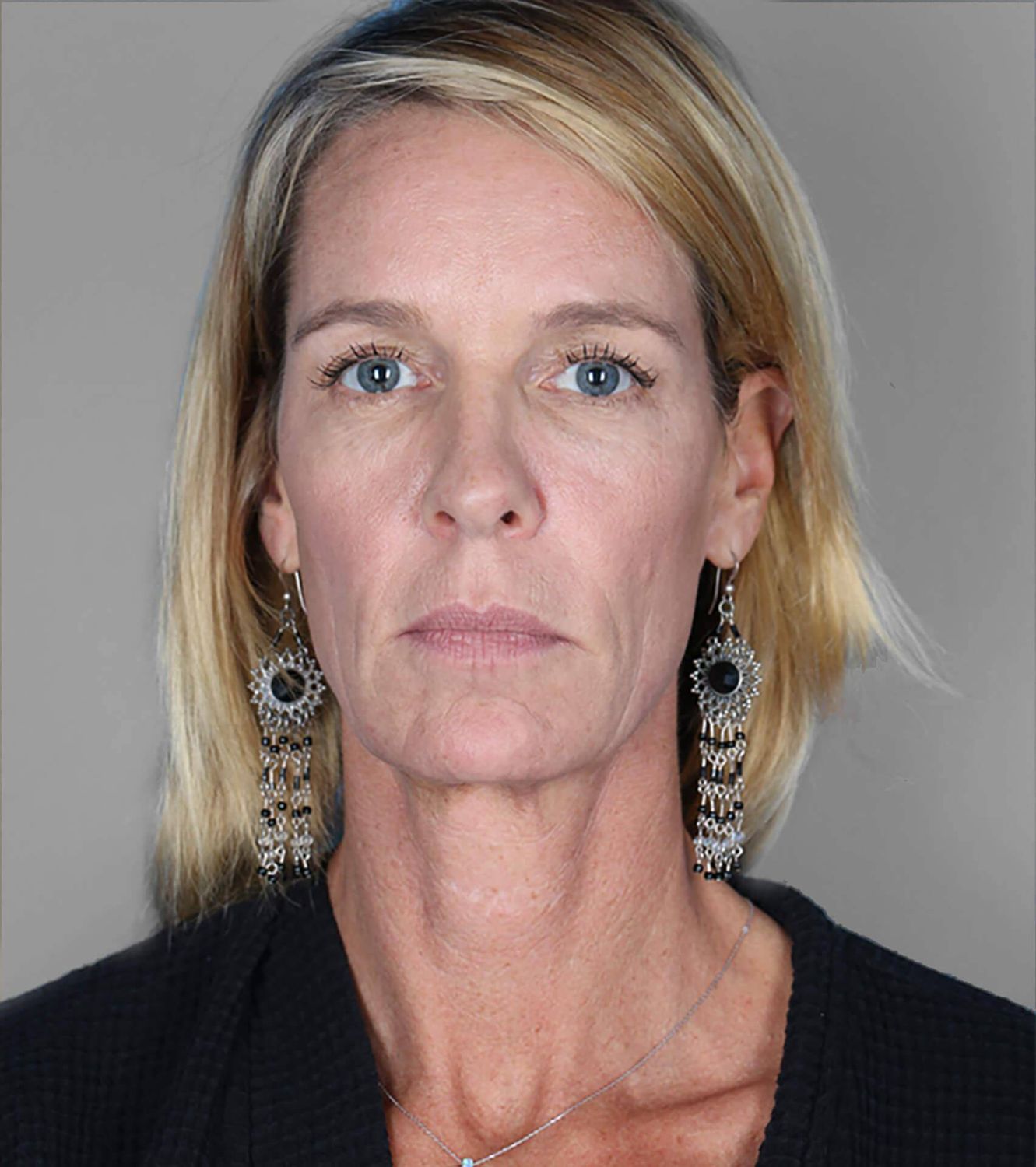 Co2 Laser Before & After