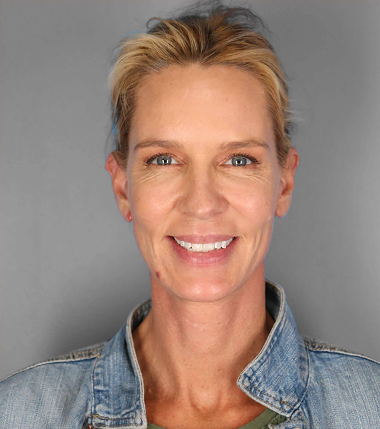 Co2 Laser Before & After