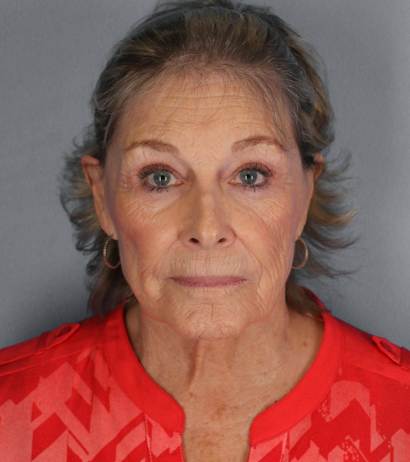 Co2 Laser Before & After