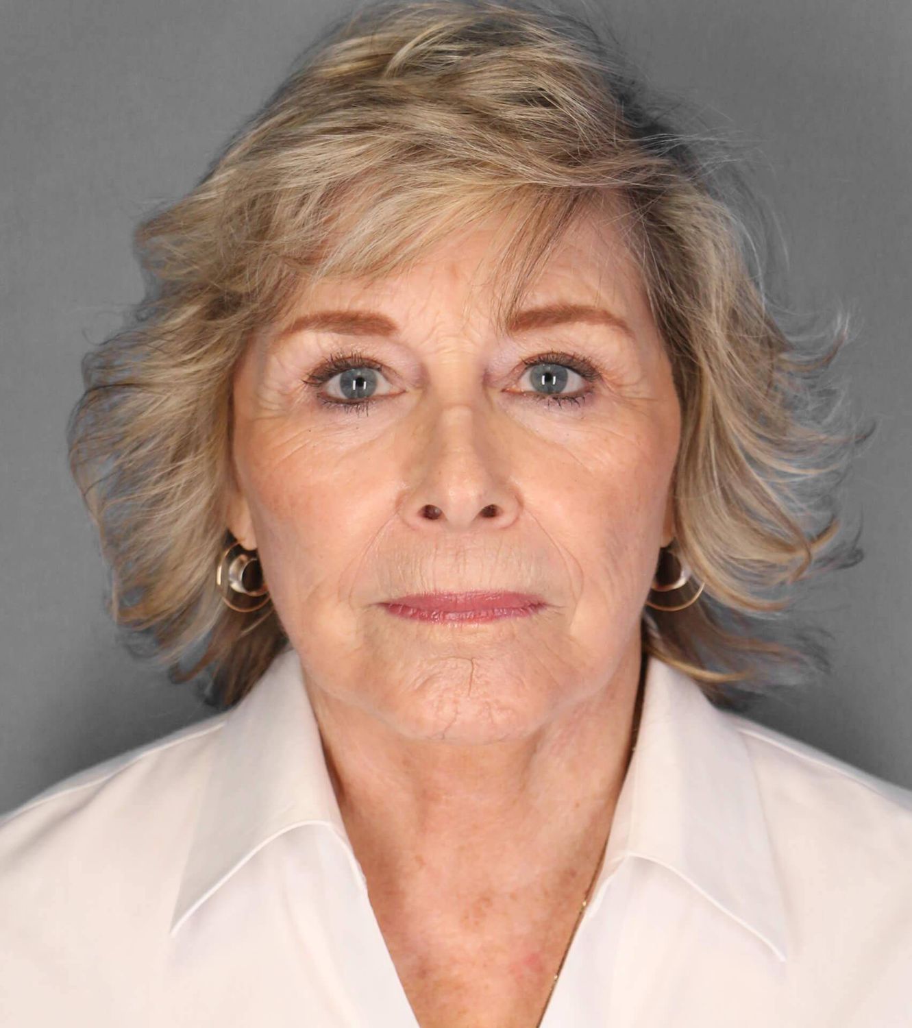 Co2 Laser Before & After