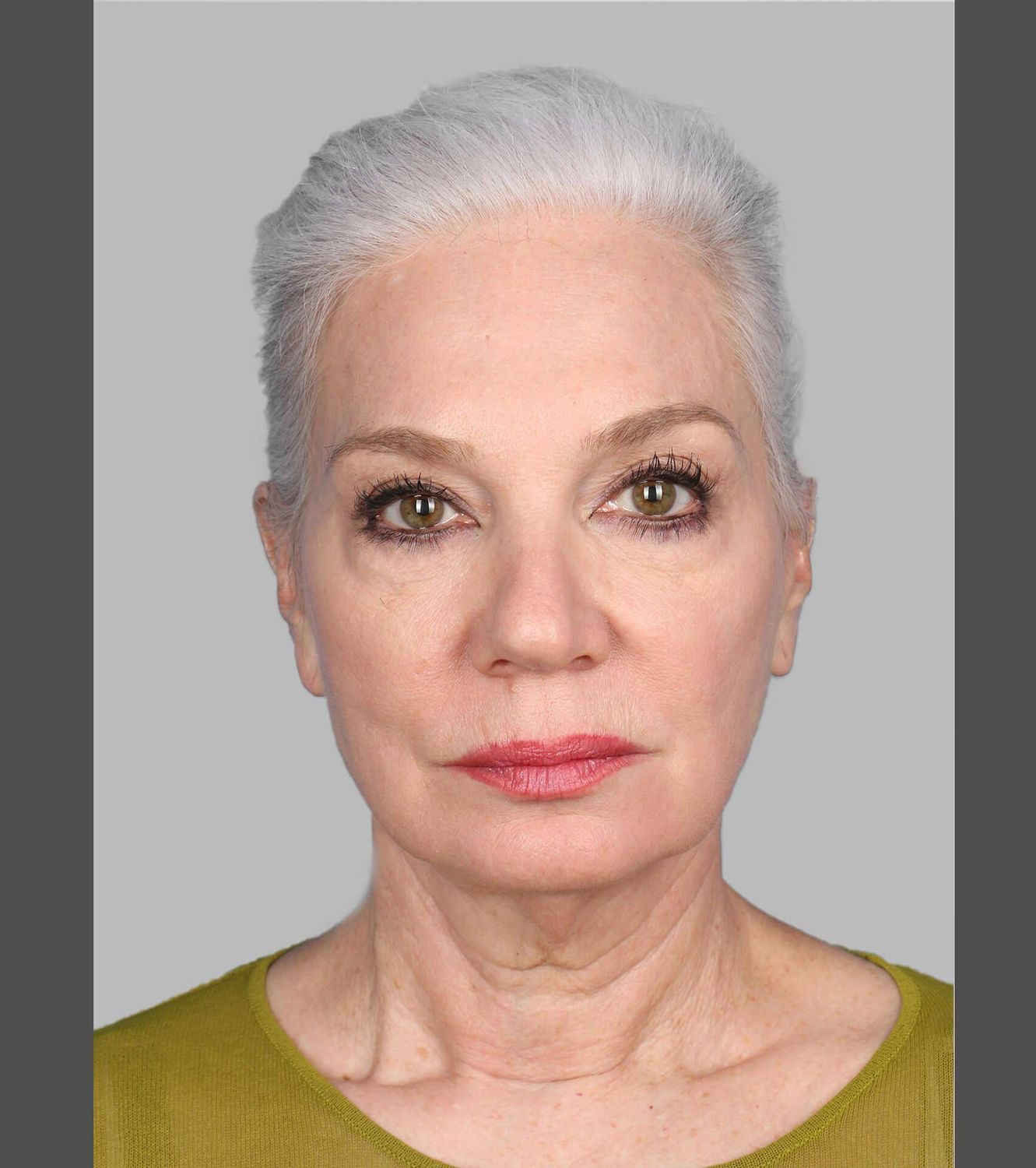 Co2 Laser Before & After