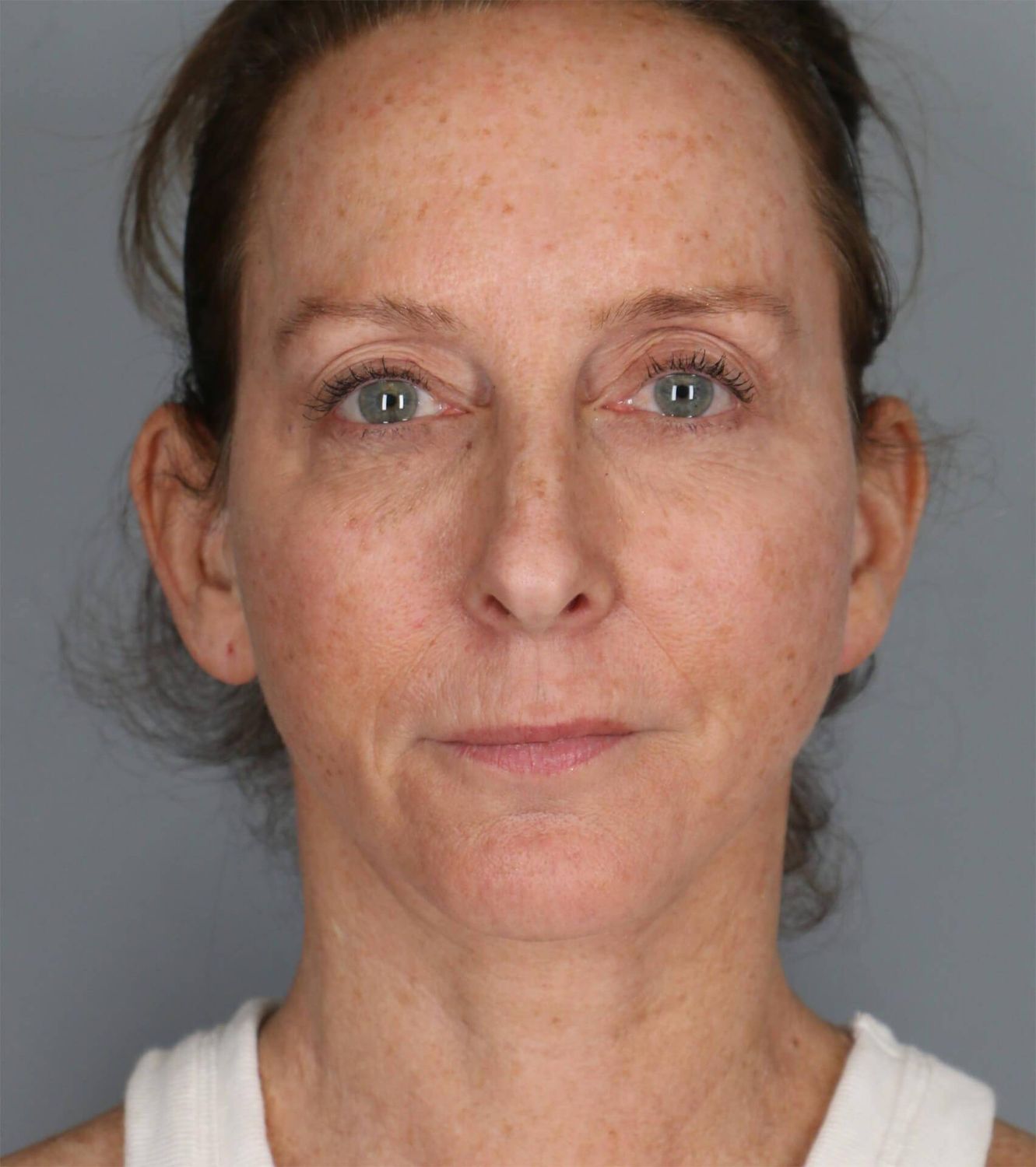 Co2 Laser Before & After