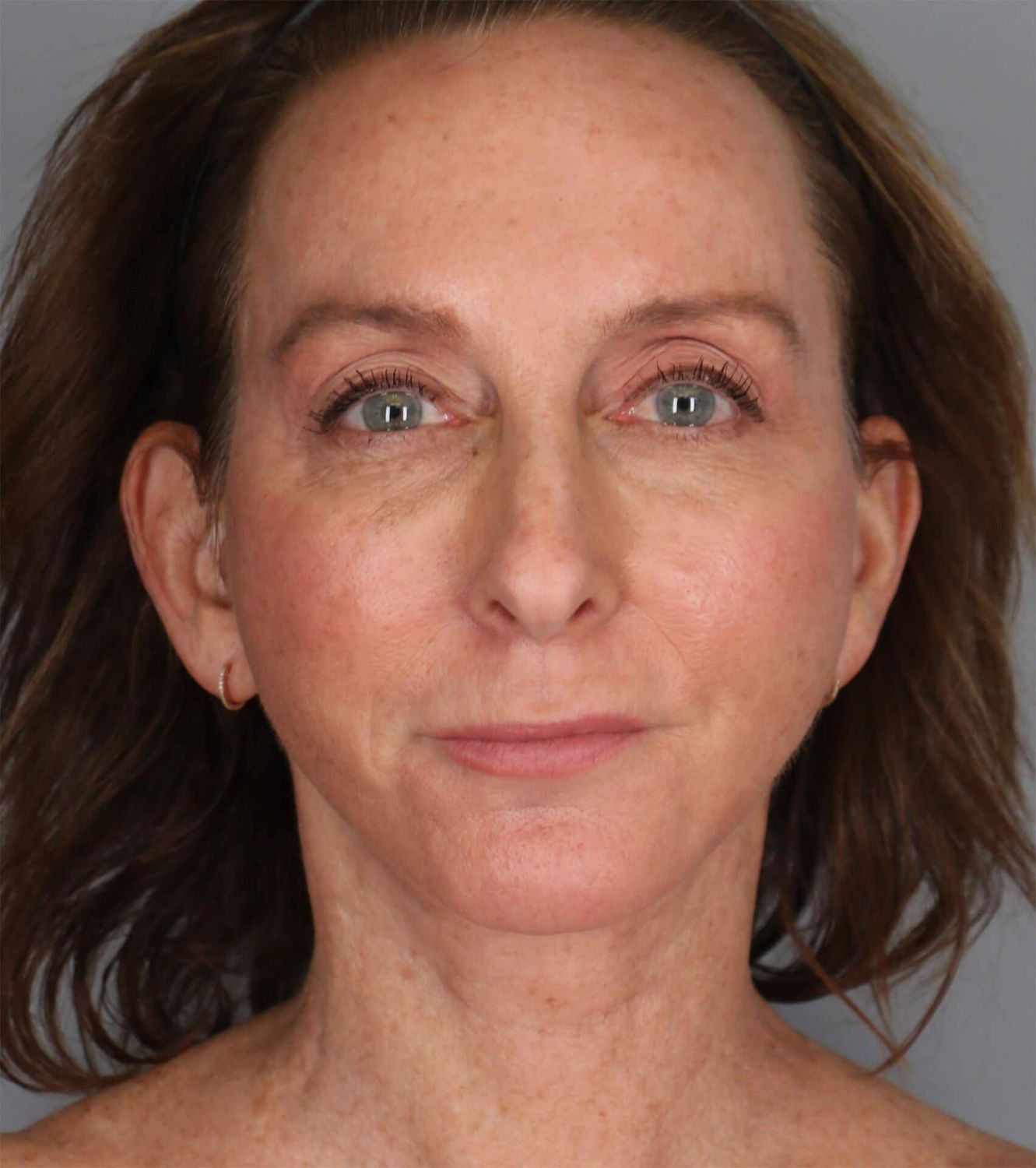 Co2 Laser Before & After