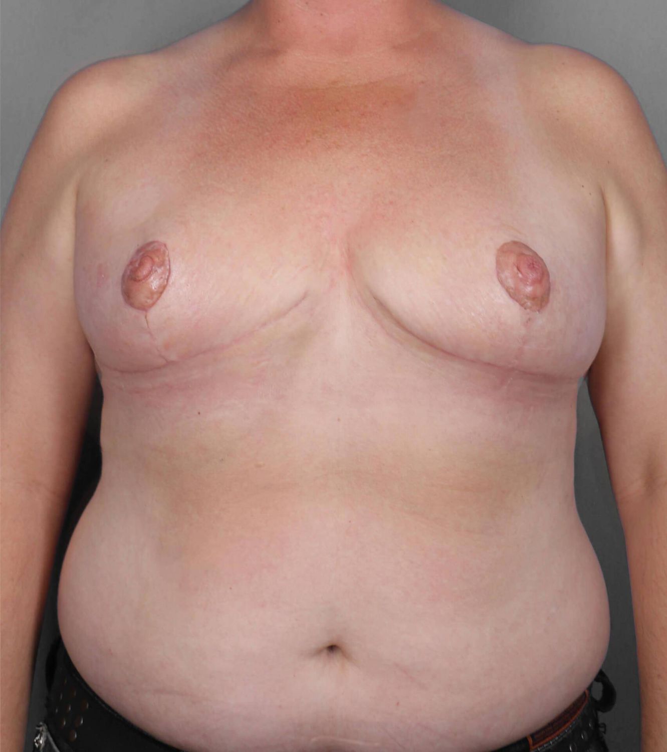 Swim Flap Before & After