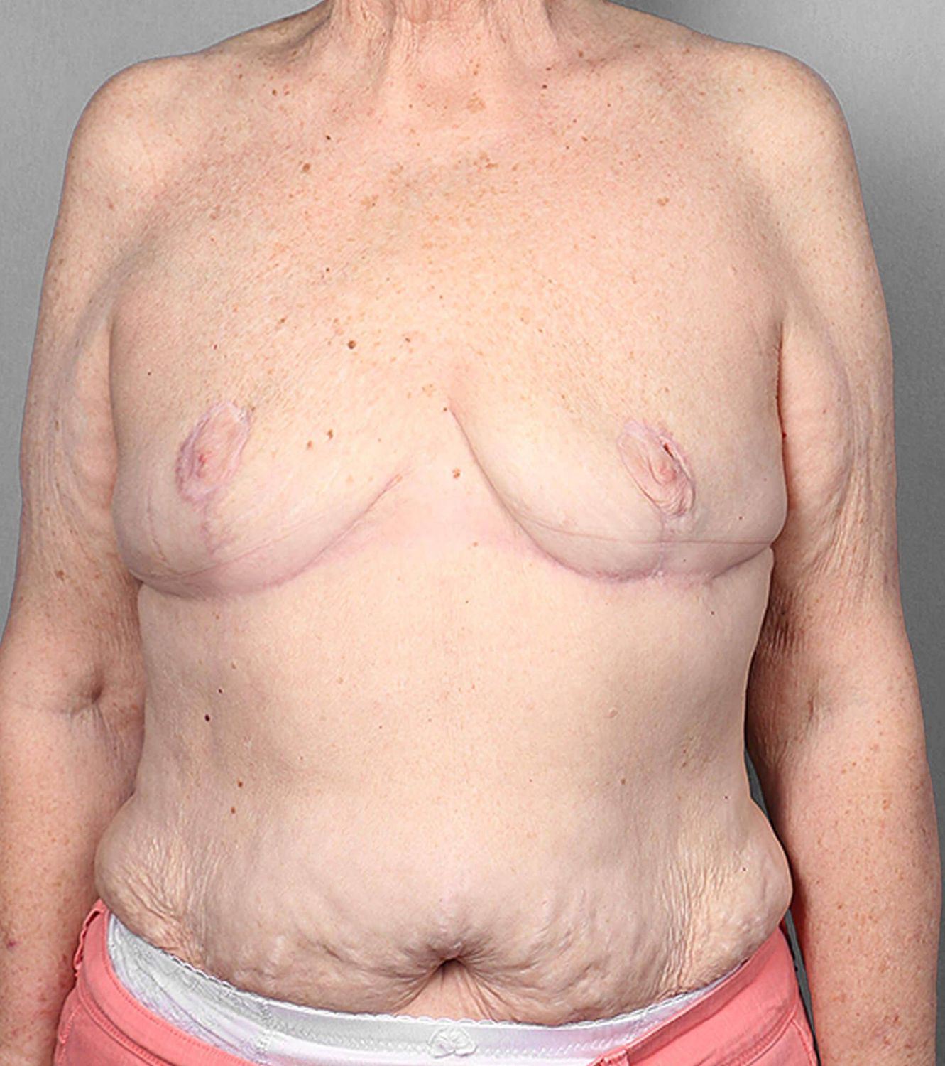 Swim Flap Before & After