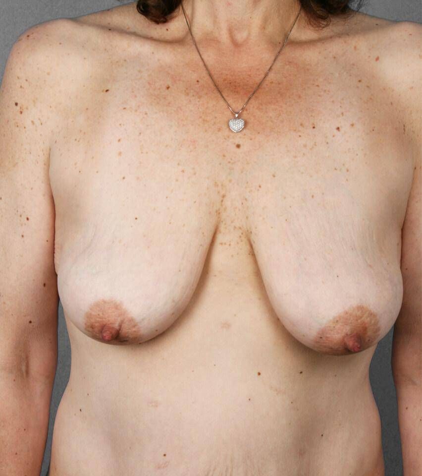 Breast Lift Before & After