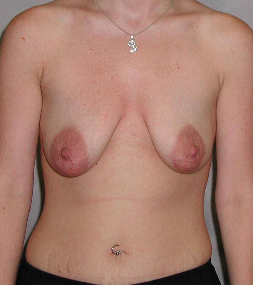 Breast Lift Before & After