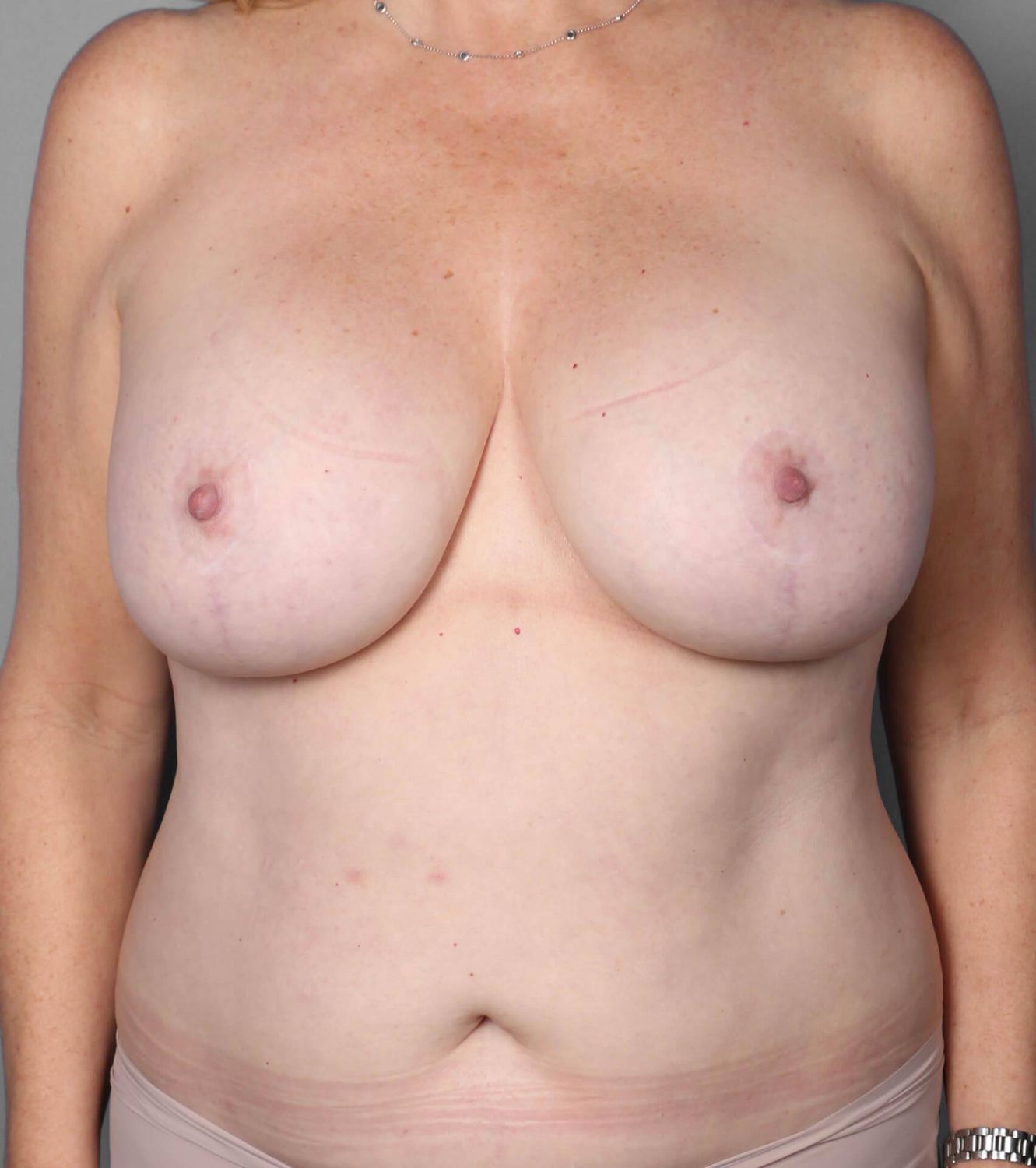 Breast Lift Before & After