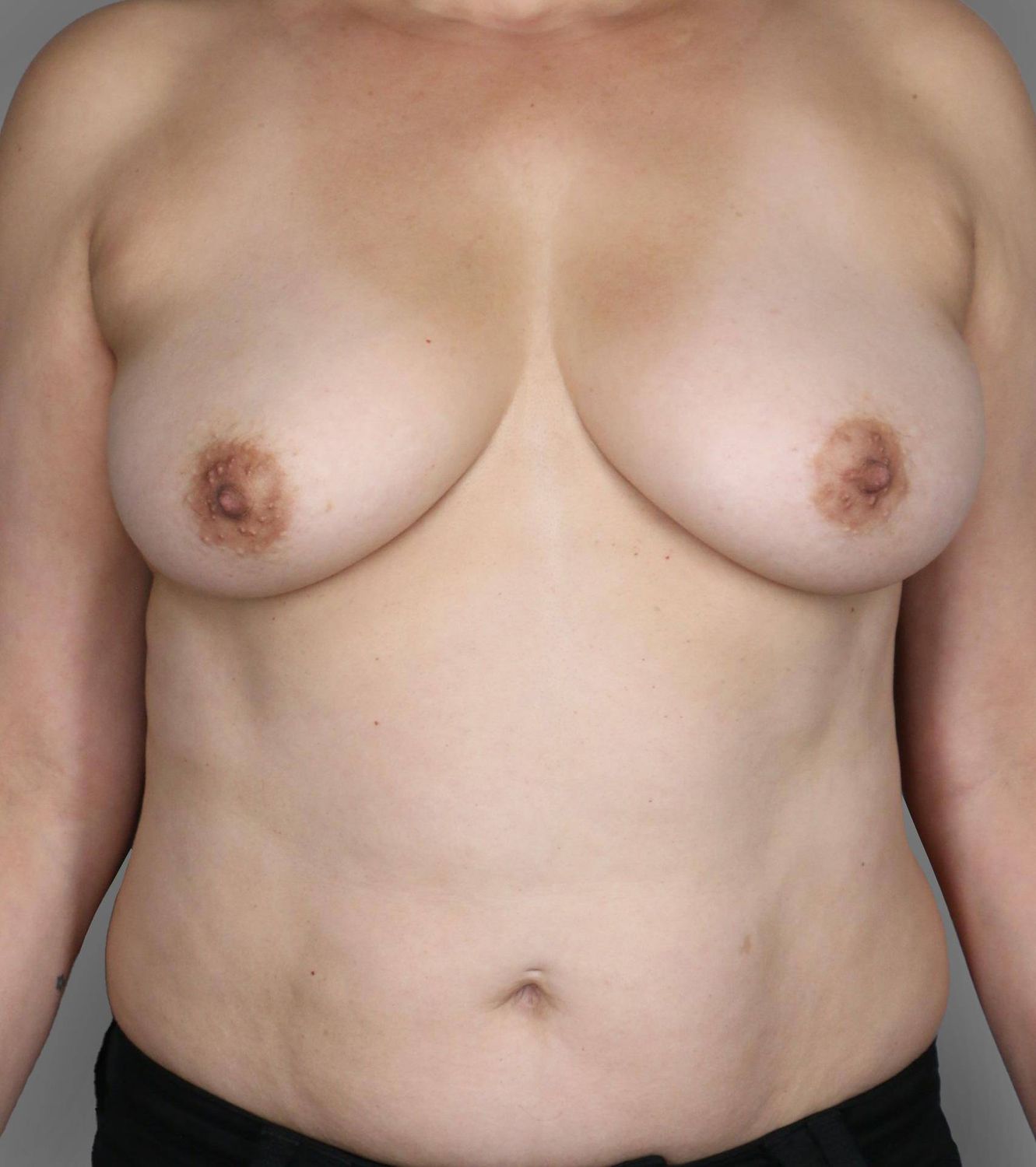 Breast Lift Before & After